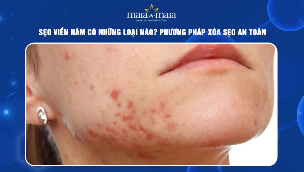 Sẹo viền hàm có những loại nào? Phương pháp xóa sẹo an toàn 1 Sẹo viền hàm
