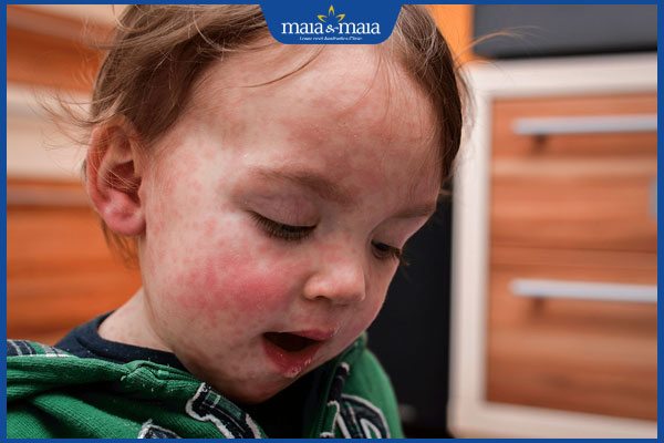 Sốt phát ban và sởi có gì khác nhau? Điều trị và phòng ngừa 8 sởi nổi ở mặt trẻ