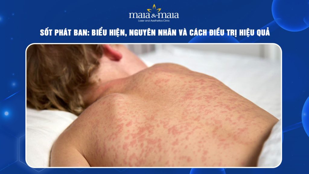 sốt phát ban