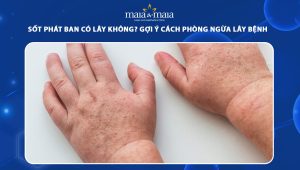 sốt phát ban có lây không