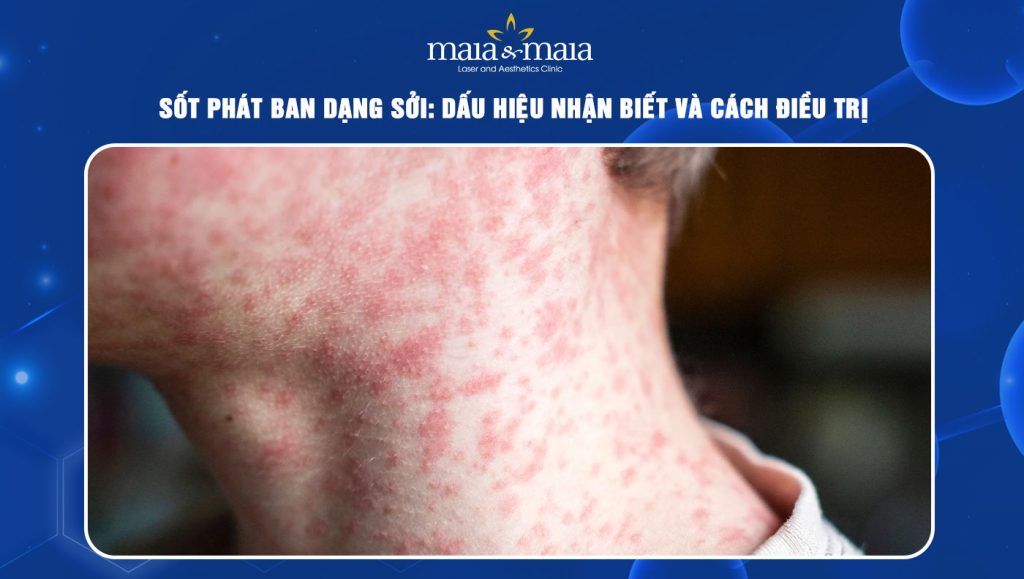 Sốt phát ban dạng sởi: Dấu hiệu nhận biết và cách điều trị 1 sốt phát ban dạng sởi