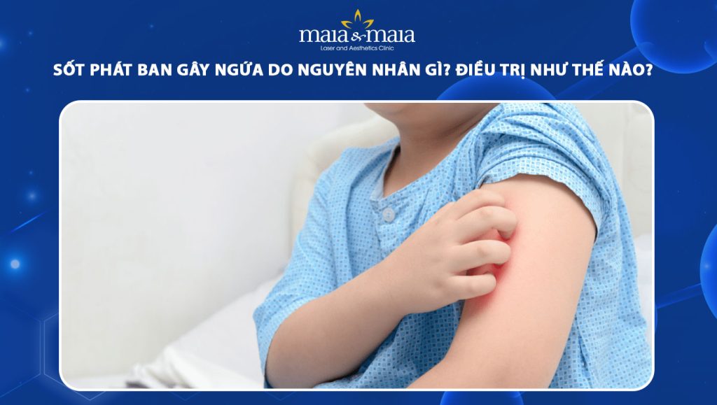 sốt phát ban gây ngứa