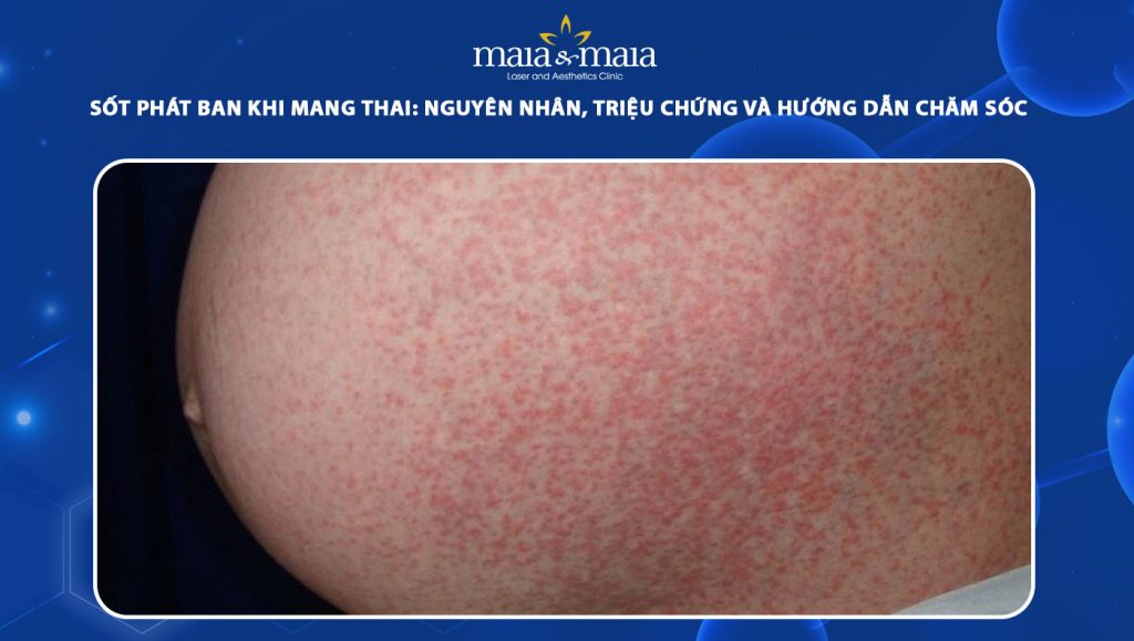 Sốt phát ban khi mang thai: Nguyên nhân và cách chăm sóc 1 sốt phát ban khi mang thai