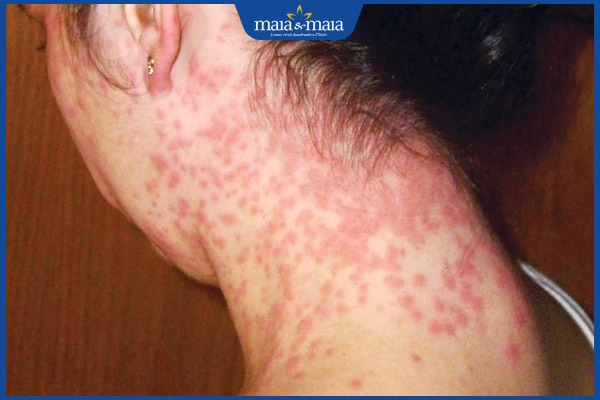 sốt phát ban lan rộng