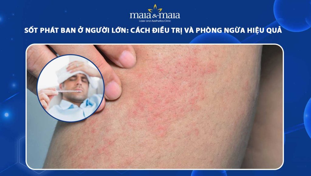 sốt phát ban ở người lớn