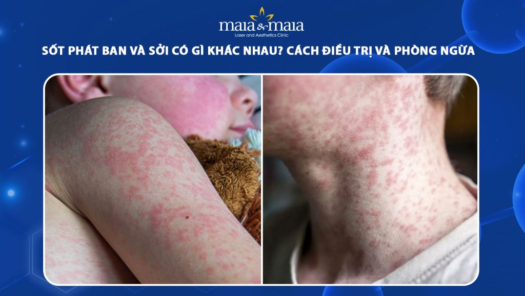 Sốt phát ban và sởi có gì khác nhau? Điều trị và phòng ngừa 1 sốt phát ban và sởi