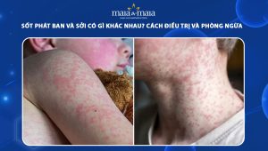 sốt phát ban và sởi