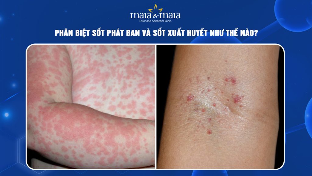 sốt phát ban và sốt xuất huyết