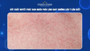 sốt xuất huyết phát ban ngứa phải làm sao