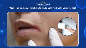 thuốc bôi chốc mép