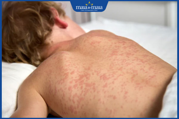 tình trạng ban đào ở trẻ em