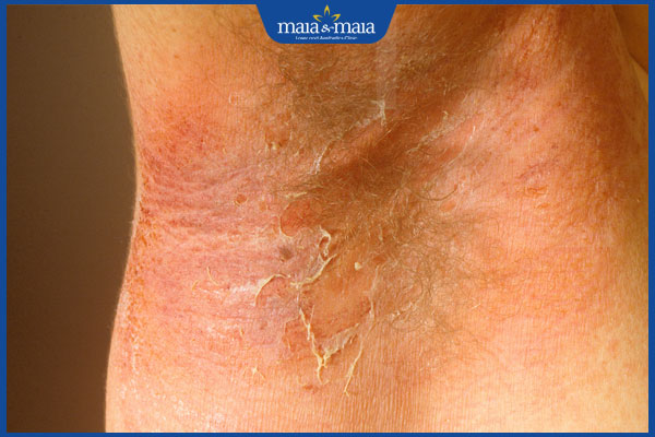 tình trạng bong vảy da do tụ cầu