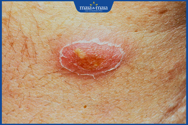 tình trạng chốc lở ở mông