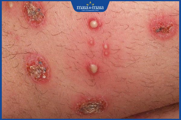 tình trạng chốc lở thể mủ