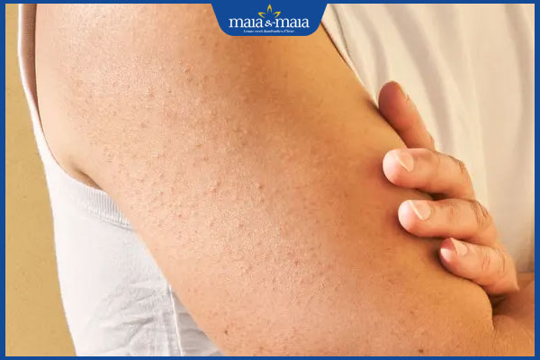 tình trạng dày sừng nang lông