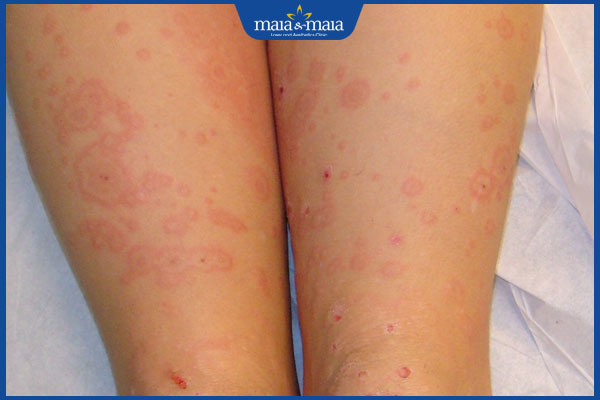 tình trạng hồng ban đa dạng