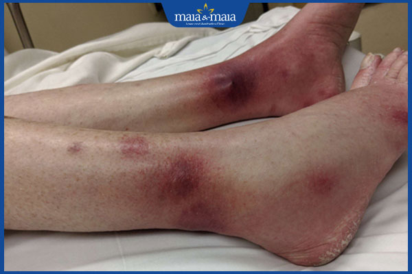 tình trạng hồng ban rắn bazin