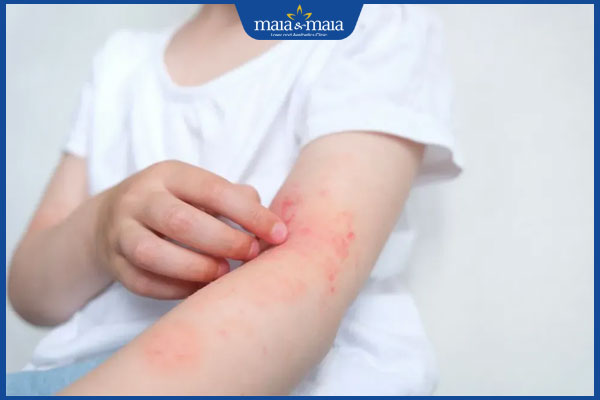 tình trạng sẩn ngứa ở trẻ em