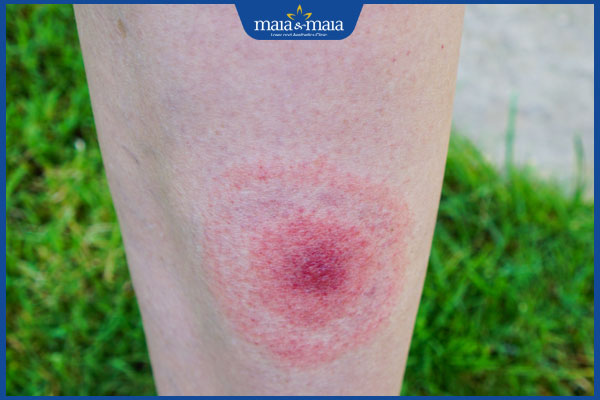 tình trạng viêm mô tế bào do côn trùng cắn