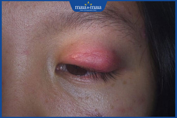 Viêm mô tế bào hốc mắt là gì? Nguyên nhân và cách điều trị 2 tình trạng viêm mô tế bào hốc mắt