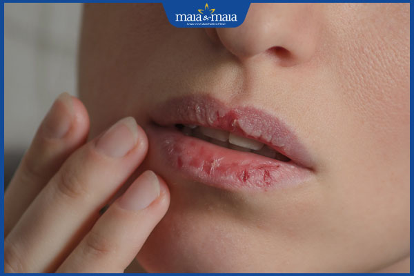 tình trạng viêm môi bong vảy