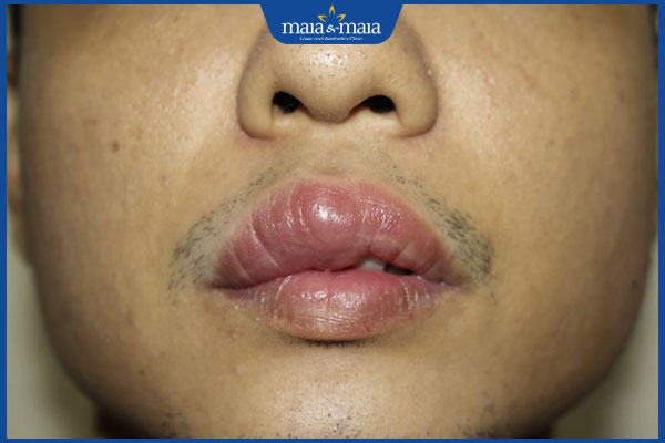 Viêm môi dạng u hạt có nguy hiểm không? Cách xử lý hiệu quả 2 tình trạng viêm môi dạng u hạt