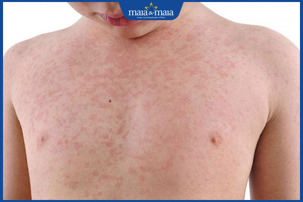 Sốt phát ban và sởi có gì khác nhau? Điều trị và phòng ngừa 2 trẻ bị sốt phát ban nổi mẩn