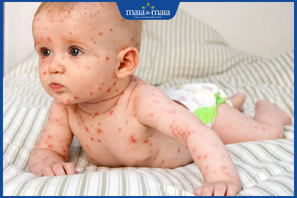 trẻ bị sốt phát ban