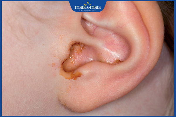 trẻ bị viêm tai giữa