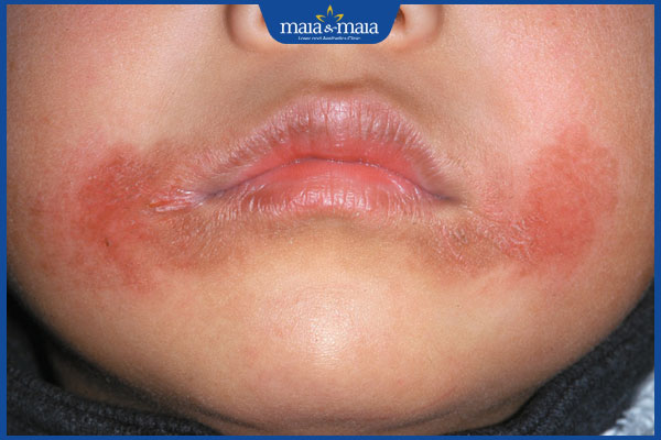 Dấu hiệu nhận biết chốc mép và phương pháp điều trị hiệu quả 3 trẻ chốc mép