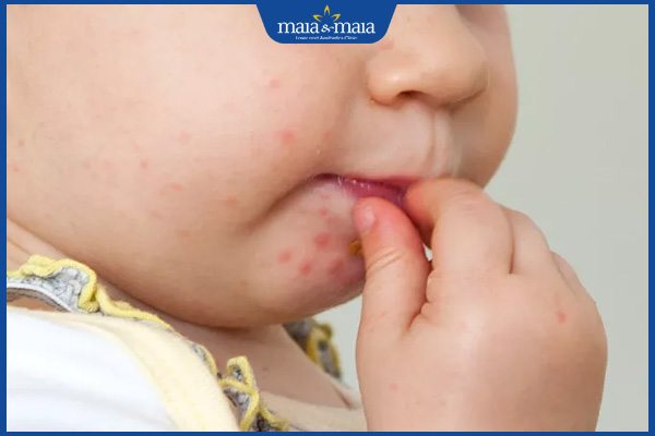 Chốc mép ở trẻ em do đâu? Điều trị và phòng tránh thế nào? 3 trẻ gãi môi