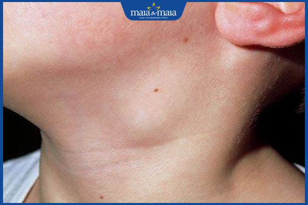 Sốt phát ban nổi hạch có dấu hiệu gì? Cách điều trị thế nào? 2 trẻ nổi hạch