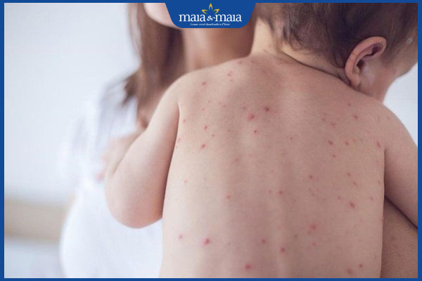 Sốt phát ban ở trẻ nguy hiểm không? Cách xử lý hiệu quả 4 trẻ nổi phát ban ở lưng