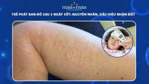 trẻ phát ban đỏ sau 3 ngày sốt