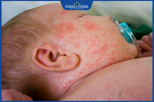 Sốt phát ban và sởi có gì khác nhau? Điều trị và phòng ngừa 7 trẻ sơ sinh nổi ban