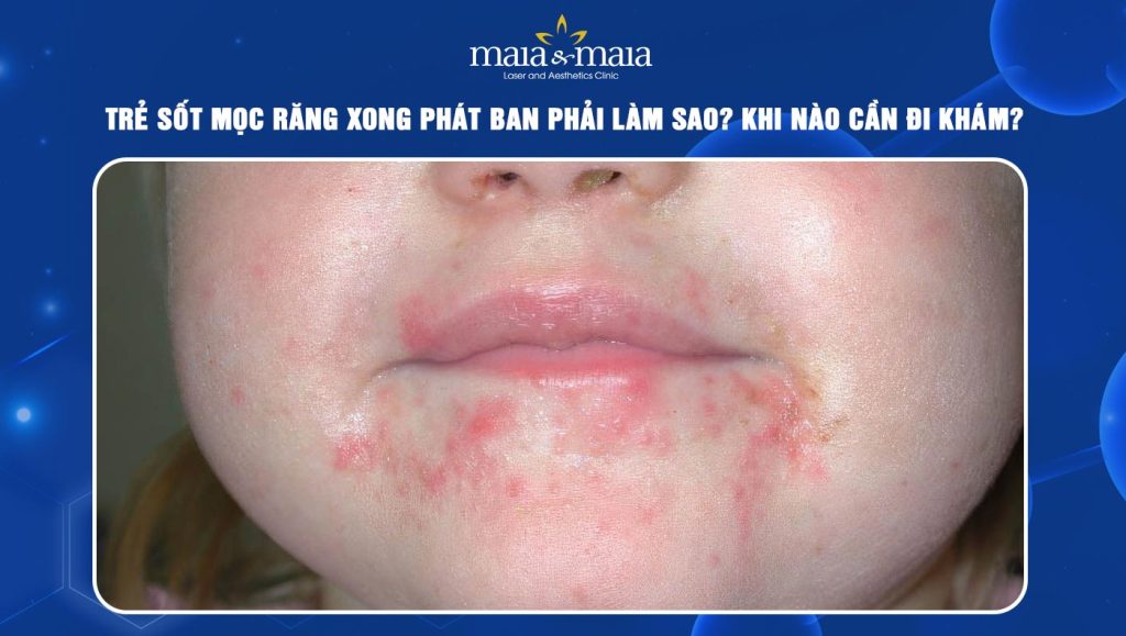 trẻ sốt mọc răng xong phát ban