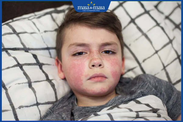 trẻ sốt phát ban mệt mỏi