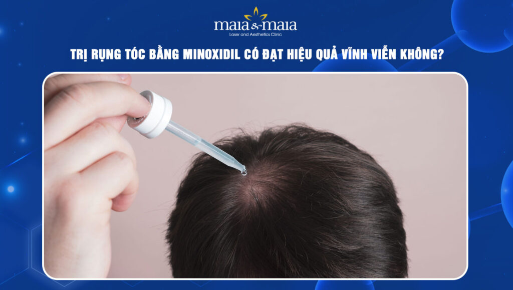 Trị rụng tóc bằng Minoxidil