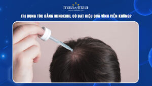 Trị rụng tóc bằng Minoxidil