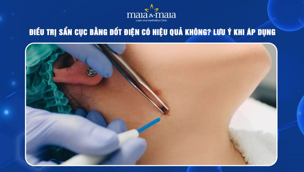 Điều trị sẩn cục bằng đốt điện có hiệu quả không? 1 trị sẩn cục bằng đốt điện