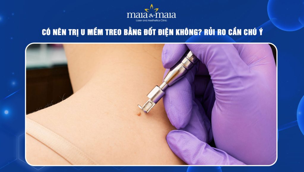 Trị u mềm treo bằng đốt điện