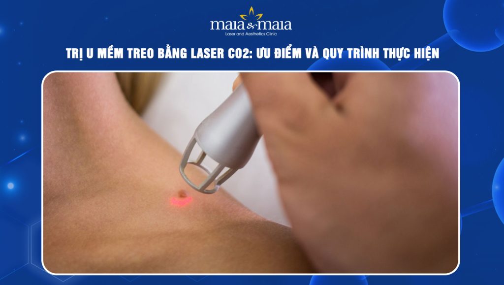 trị u mềm treo bằng laser CO2
