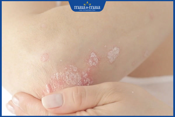 tróc vảy trắng và ngứa