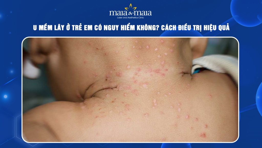 U mềm lây ở trẻ em nguy hiểm không? Cách điều trị hiệu quả 1 U mềm lây ở trẻ em