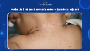 U mềm lây ở trẻ em