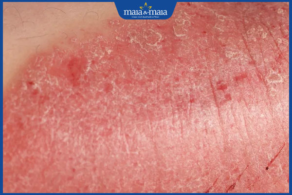 vảy nến sinh dục