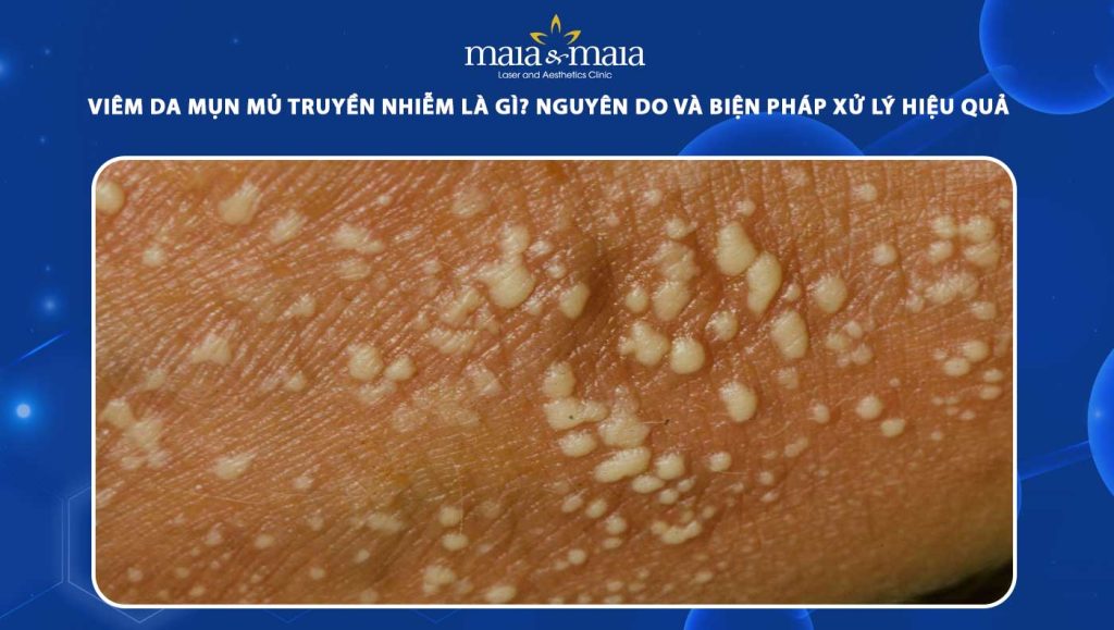viêm da mụn mủ truyền nhiễm