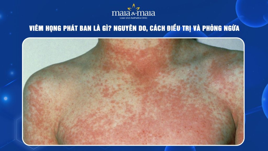 Viêm họng phát ban