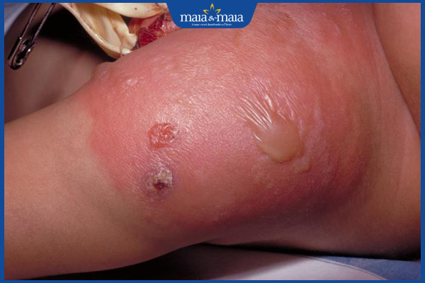 Viêm mô tế bào: Phương pháp chẩn đoán và điều trị hiệu quả 6 viêm mô gây áp xe