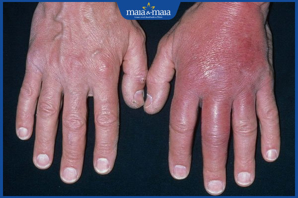 Viêm mô tế bào: Phương pháp chẩn đoán và điều trị hiệu quả 4 viêm mô ở tay